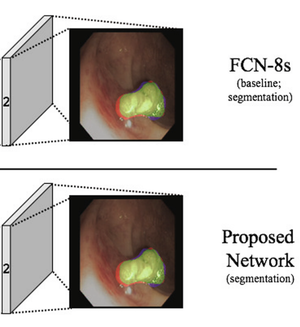 Real-Time Polyps Segmentation for Colonoscopy Video Frames Using Compressed Fully Convolutional Network